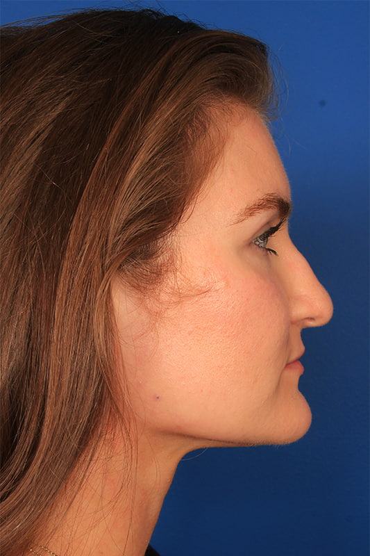 Rhinoplasty Before & After Photo