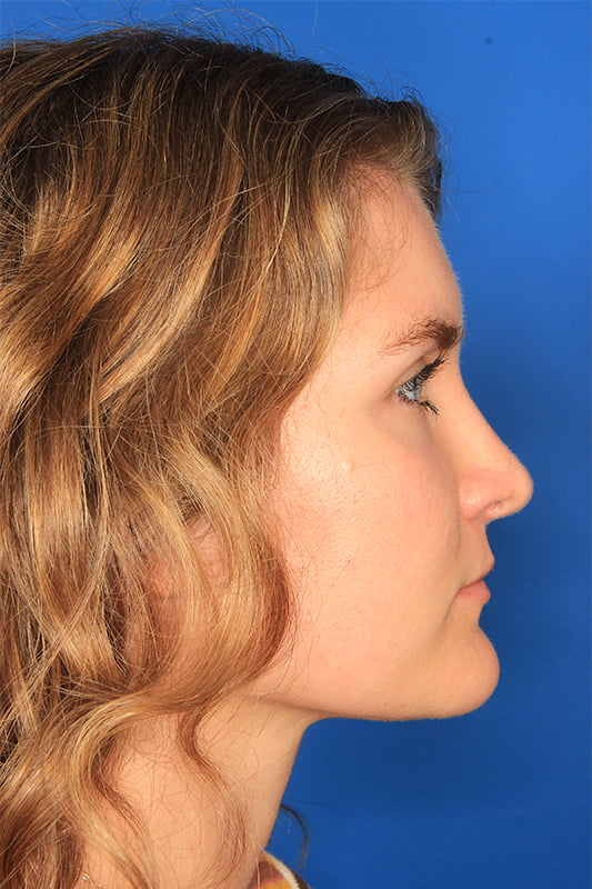 Rhinoplasty Before & After Photo