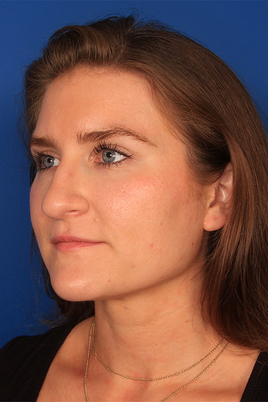 Rhinoplasty Before & After Photo