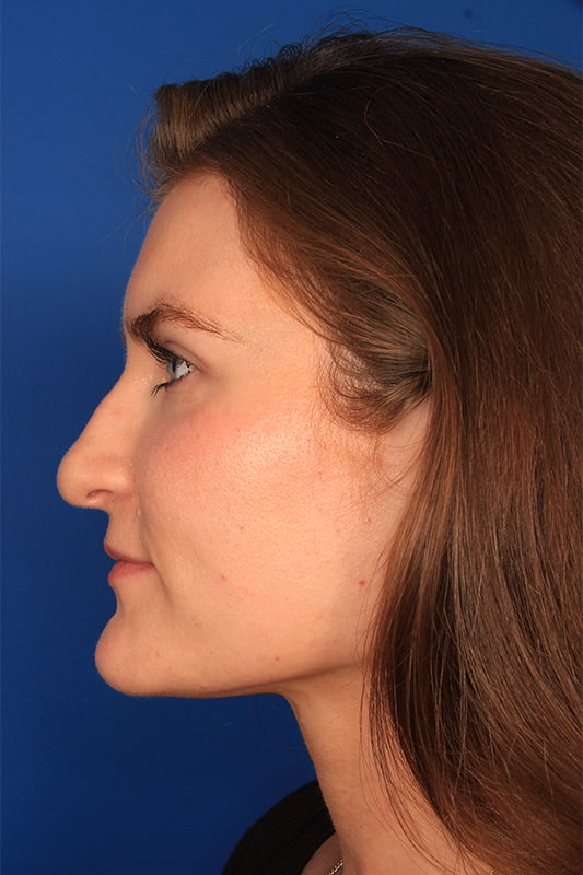 Rhinoplasty Before & After Photo