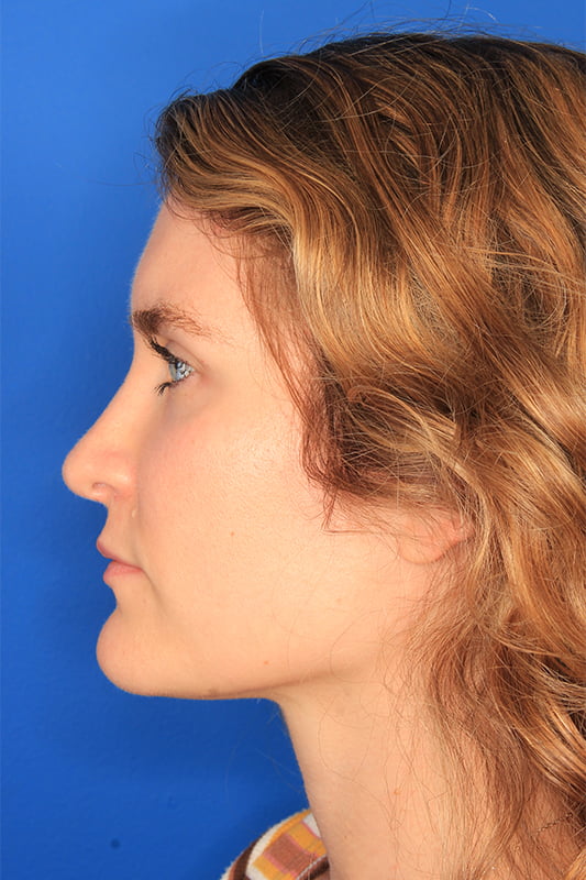 Rhinoplasty Before & After Photo