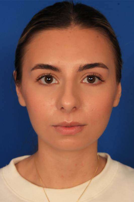 Rhinoplasty Before & After Photo