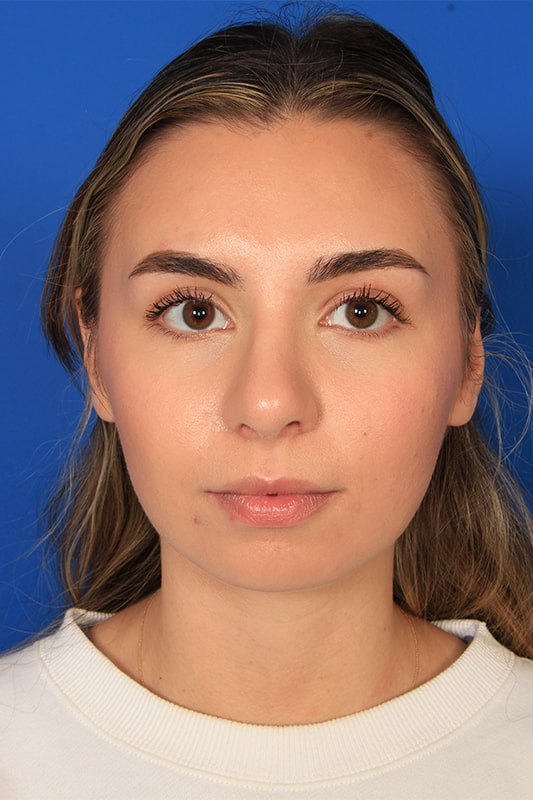 Rhinoplasty Before & After Photo