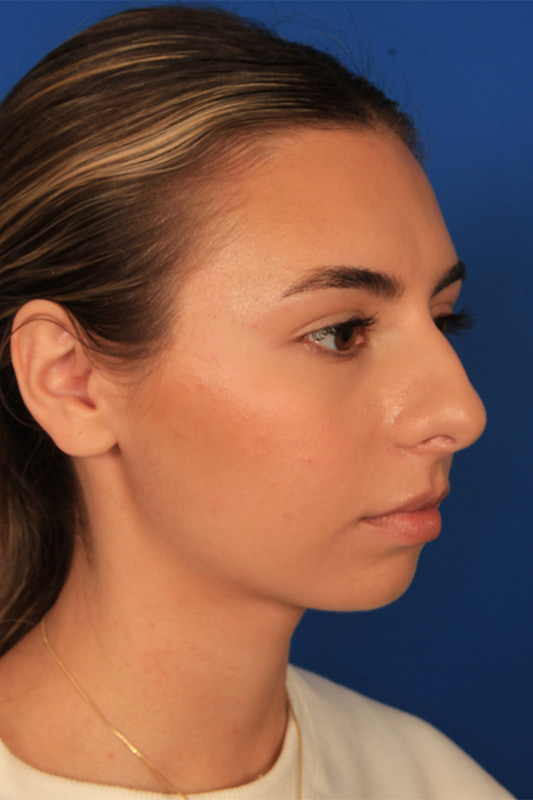 Rhinoplasty Before & After Photo