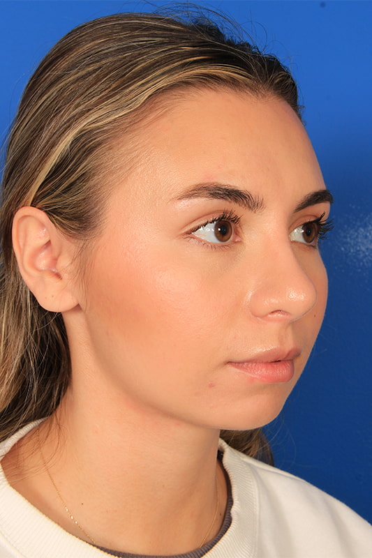 Rhinoplasty Before & After Photo