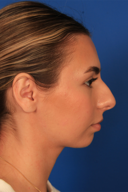 Rhinoplasty Before & After Photo