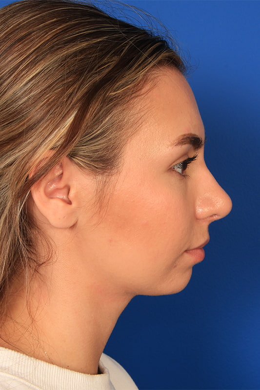 Rhinoplasty Before & After Photo