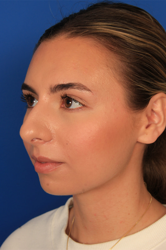 Rhinoplasty Before & After Photo