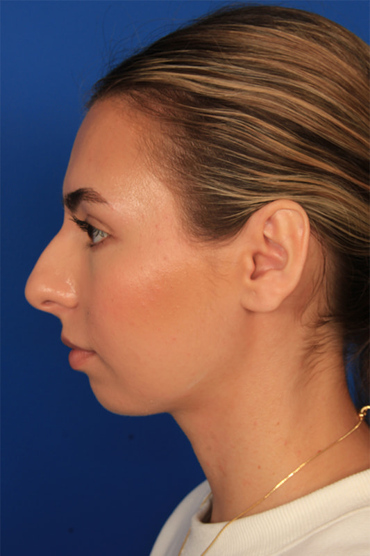 Rhinoplasty Before & After Photo