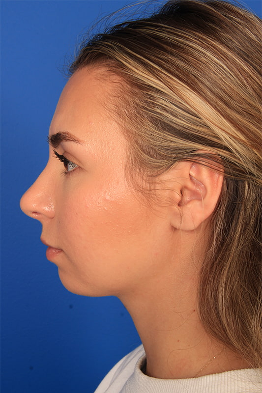 Rhinoplasty Before & After Photo