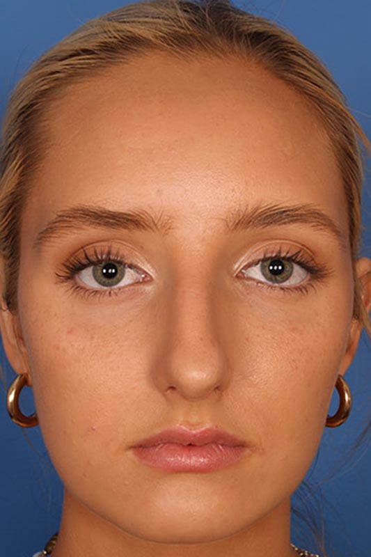 Rhinoplasty Before & After Photo