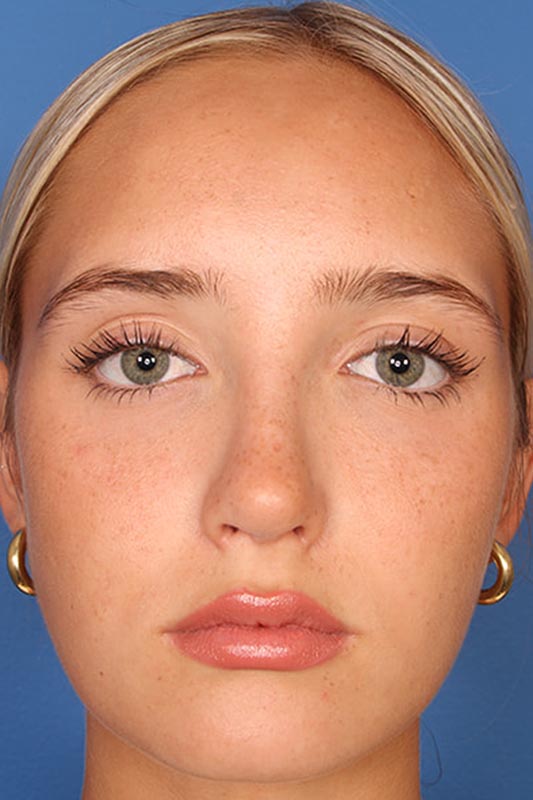 Rhinoplasty Before & After Photo