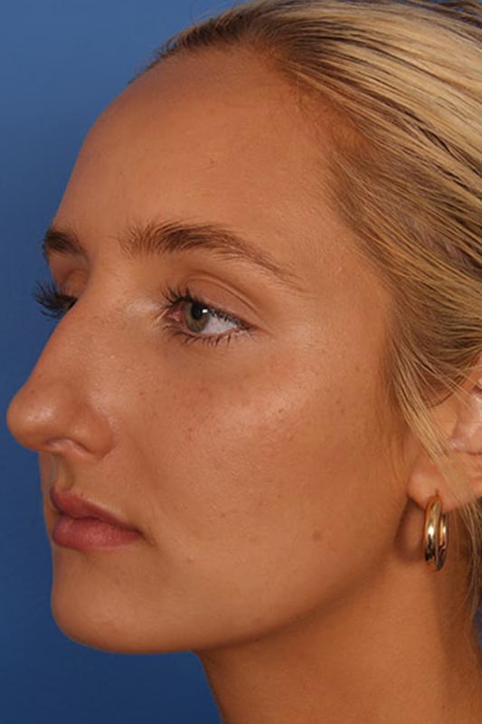 Rhinoplasty Before & After Photo