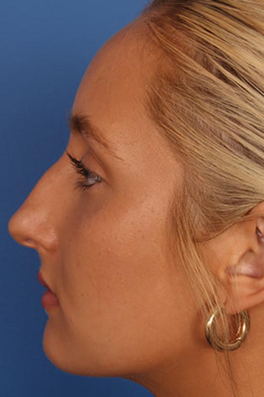 Rhinoplasty Before & After Photo