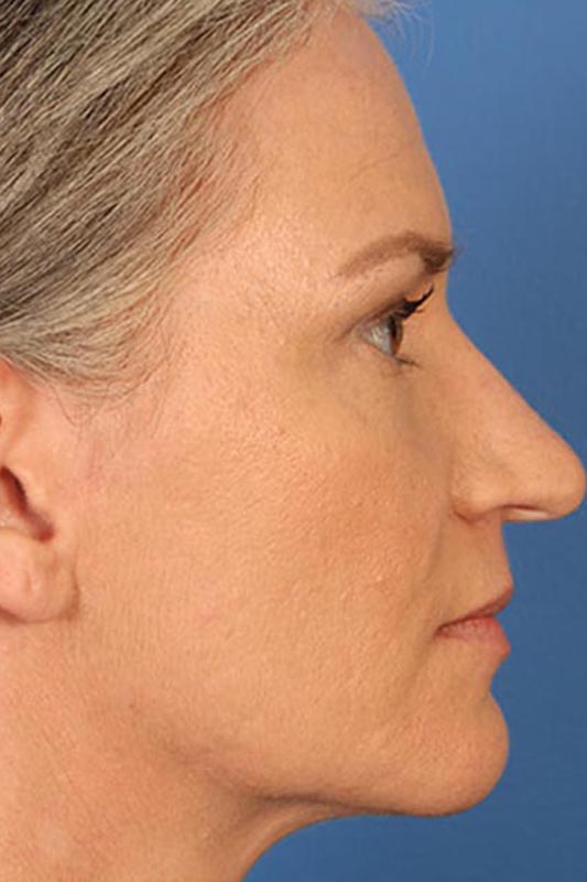 Rhinoplasty Before & After Photo