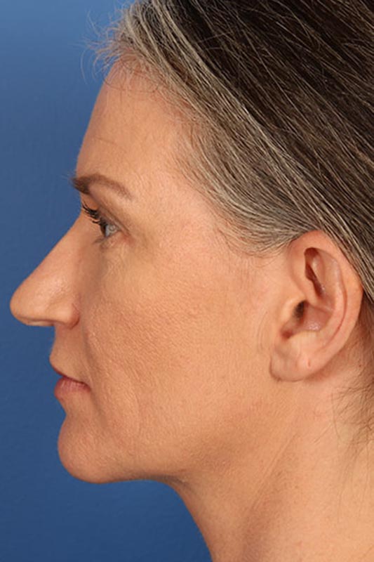 Rhinoplasty Before & After Photo