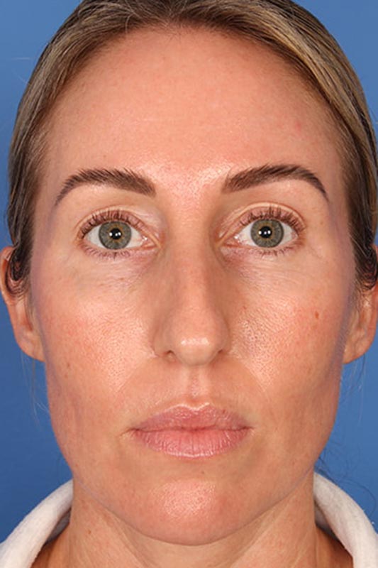 Rhinoplasty Before & After Photo