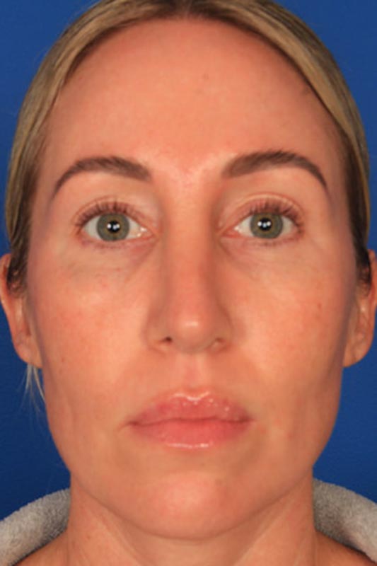 Rhinoplasty Before & After Photo