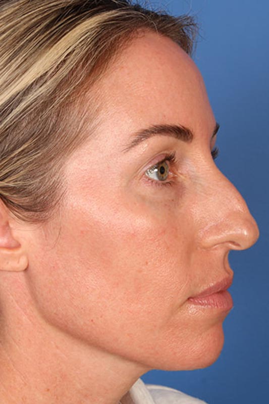 Rhinoplasty Before & After Photo