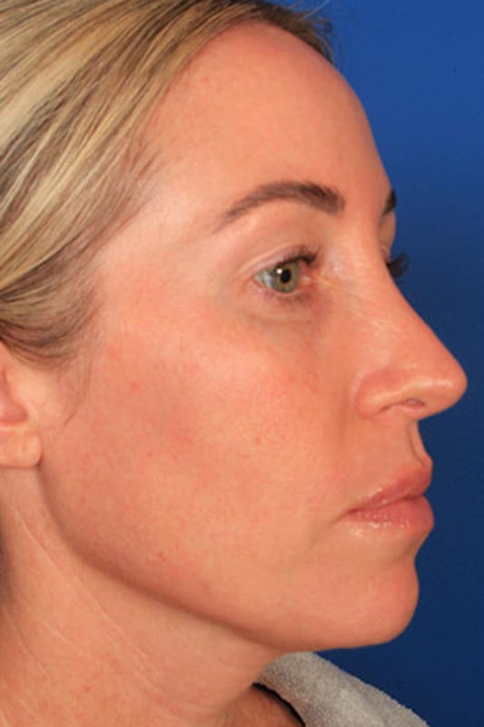 Rhinoplasty Before & After Photo