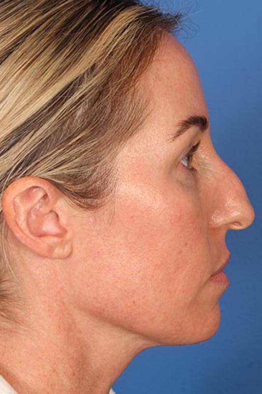 Rhinoplasty Before & After Photo