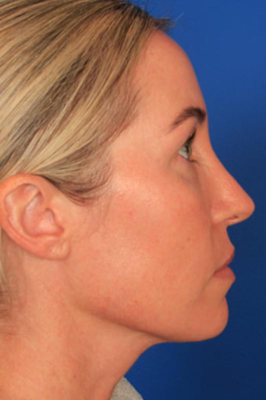 Rhinoplasty Before & After Photo