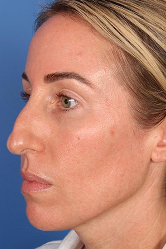 Rhinoplasty Before & After Photo