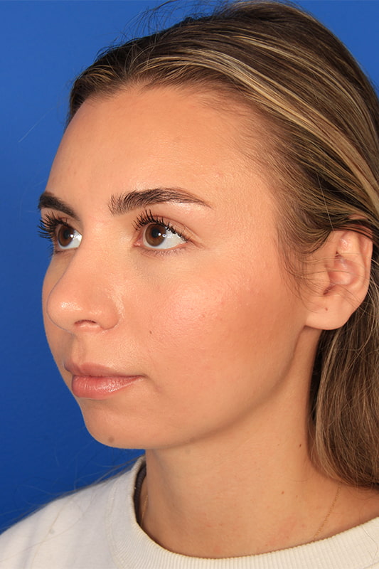 Rhinoplasty Before & After Photo