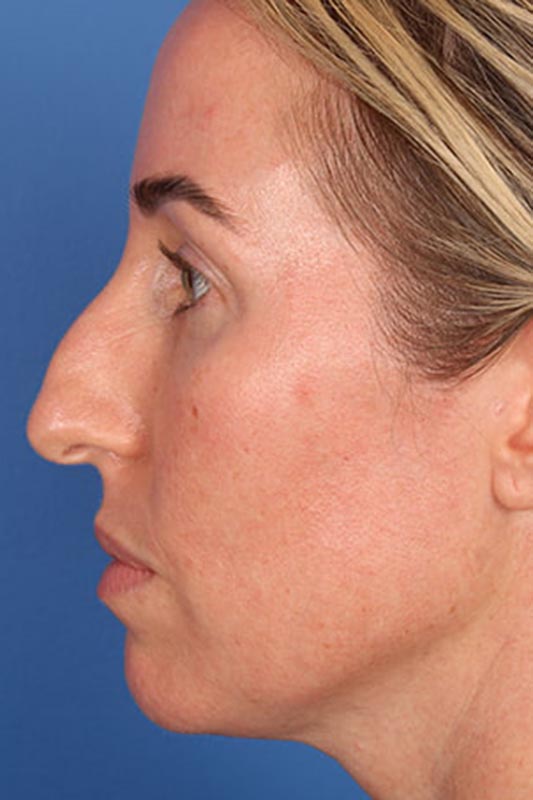 Rhinoplasty Before & After Photo