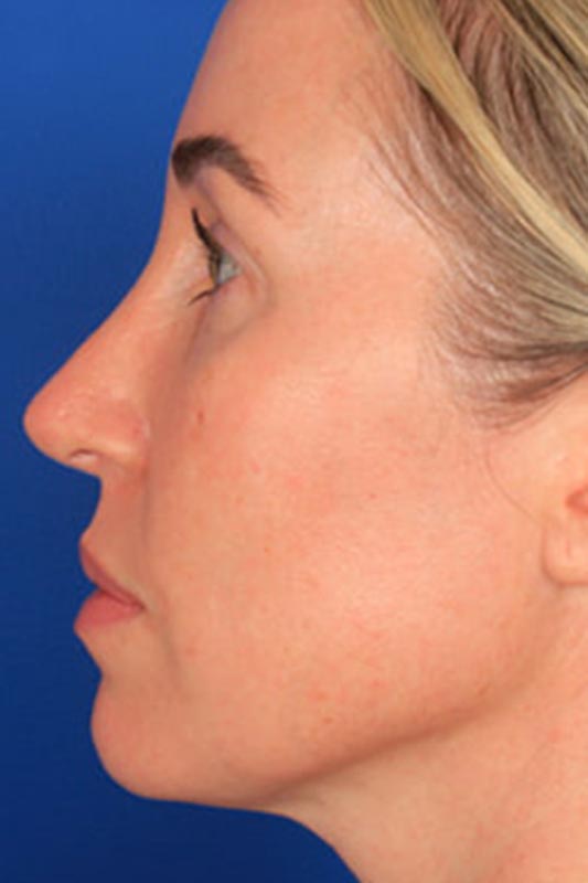 Rhinoplasty Before & After Photo