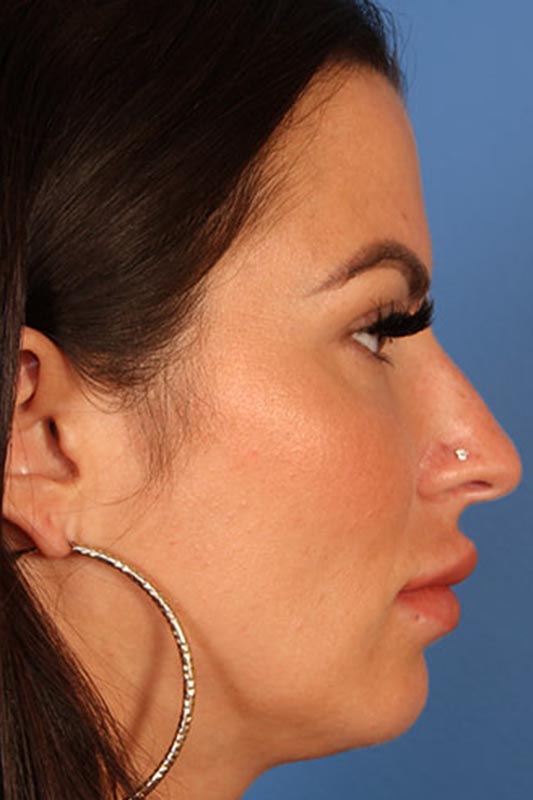 Rhinoplasty Before & After Photo