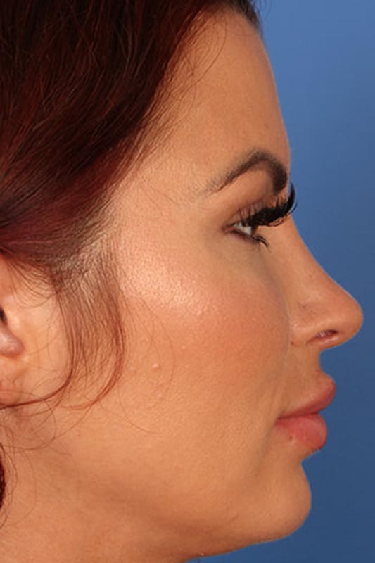 Rhinoplasty Before & After Photo