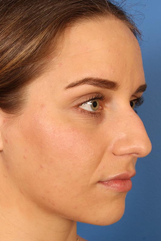 Rhinoplasty Before & After Photo