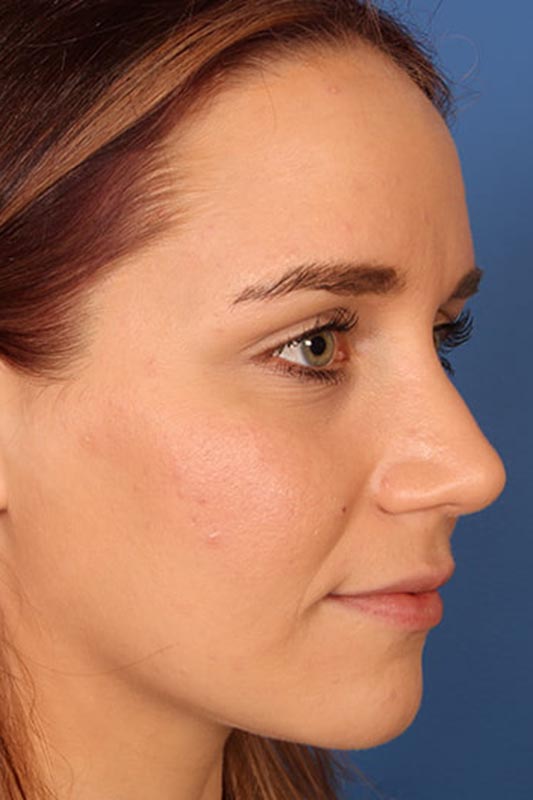 Rhinoplasty Before & After Photo