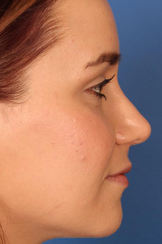 Rhinoplasty Before & After Photo