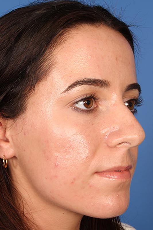 Rhinoplasty Before & After Photo