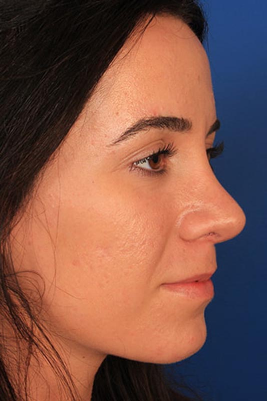 Rhinoplasty Before & After Photo