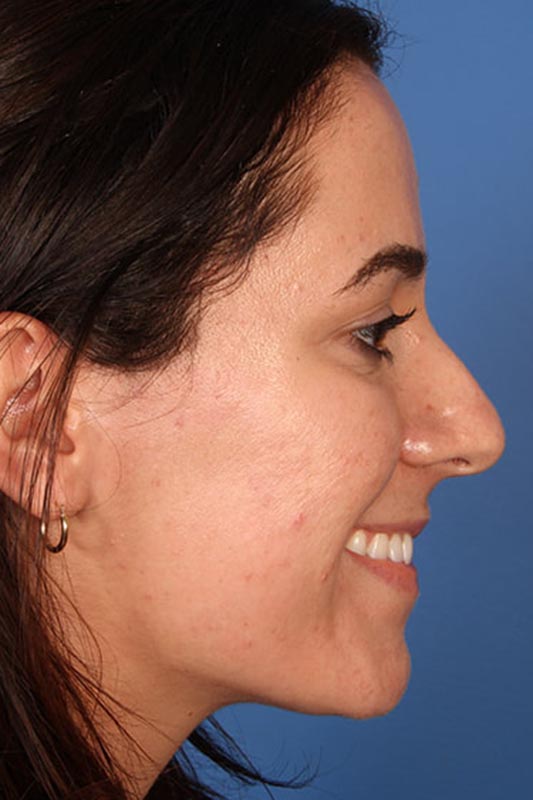 Rhinoplasty Before & After Photo