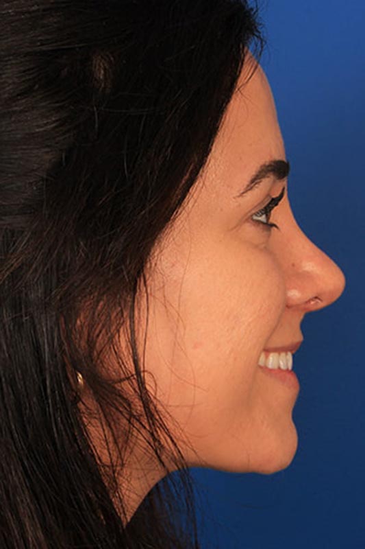 Rhinoplasty Before & After Photo