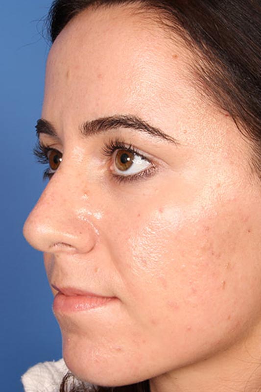 Rhinoplasty Before & After Photo