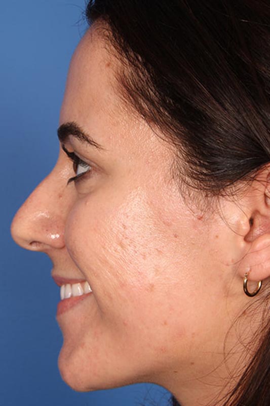 Rhinoplasty Before & After Photo