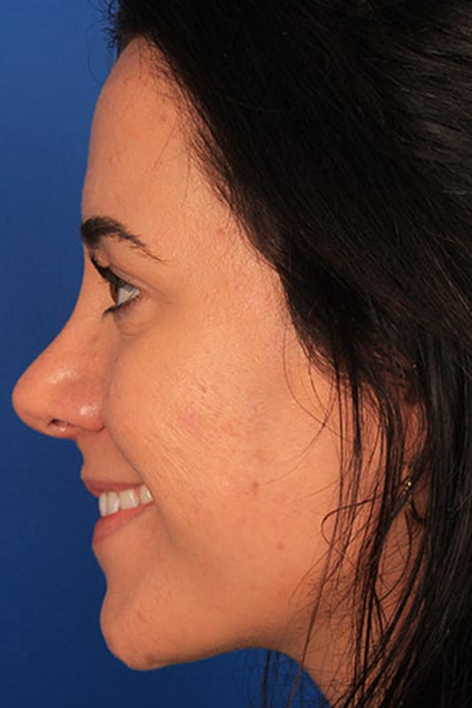 Rhinoplasty Before & After Photo