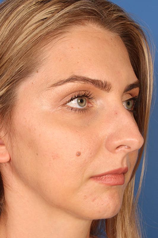 Rhinoplasty Before & After Photo