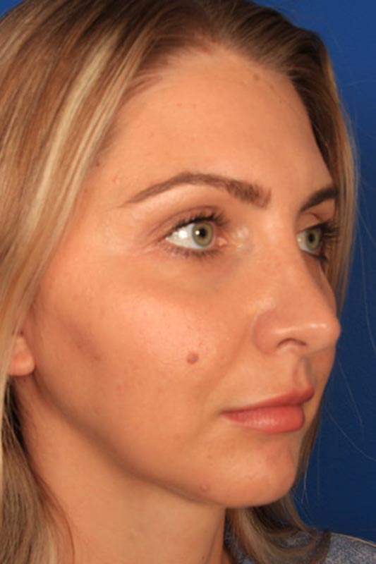 Rhinoplasty Before & After Photo