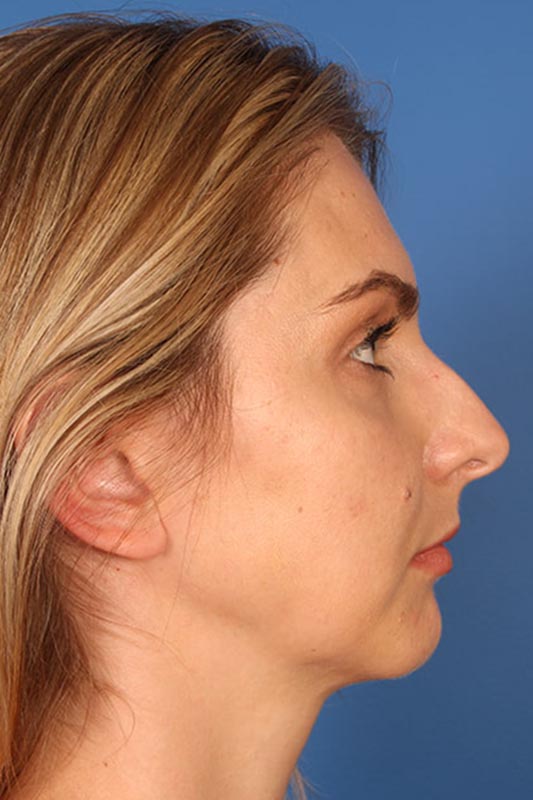 Rhinoplasty Before & After Photo