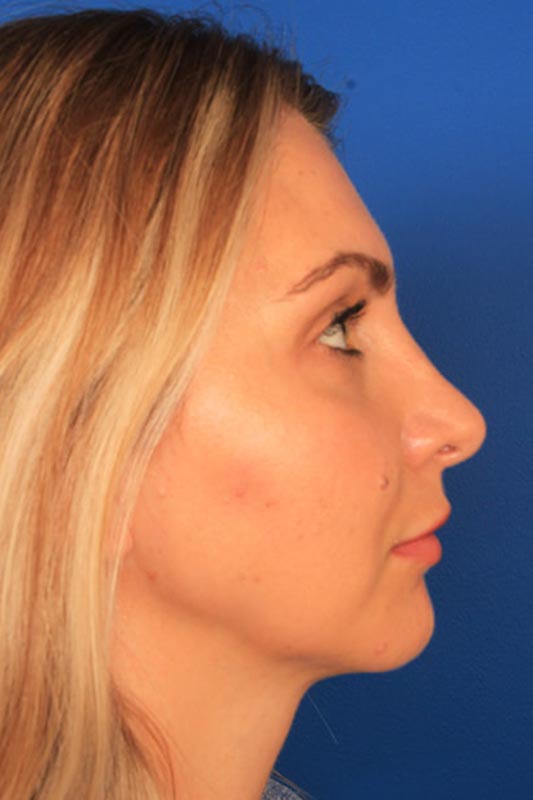 Rhinoplasty Before & After Photo