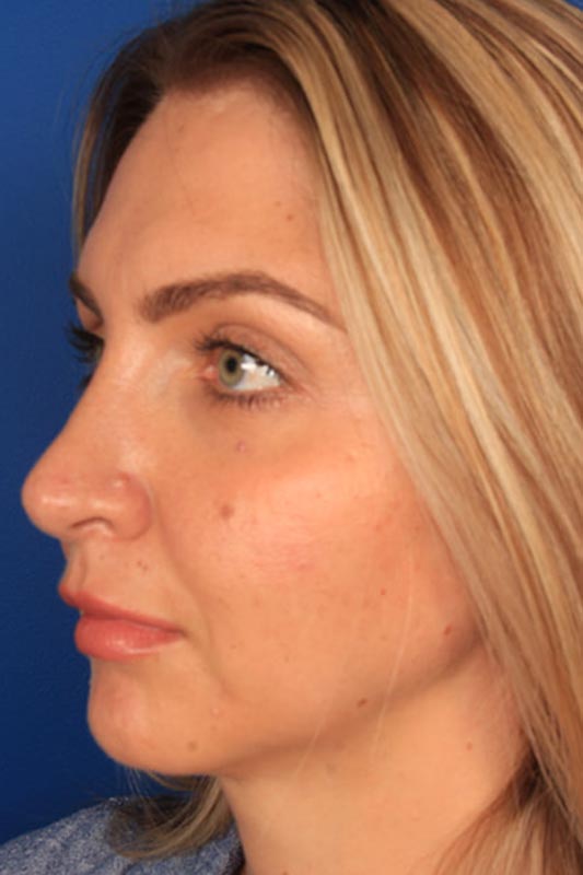 Rhinoplasty Before & After Photo