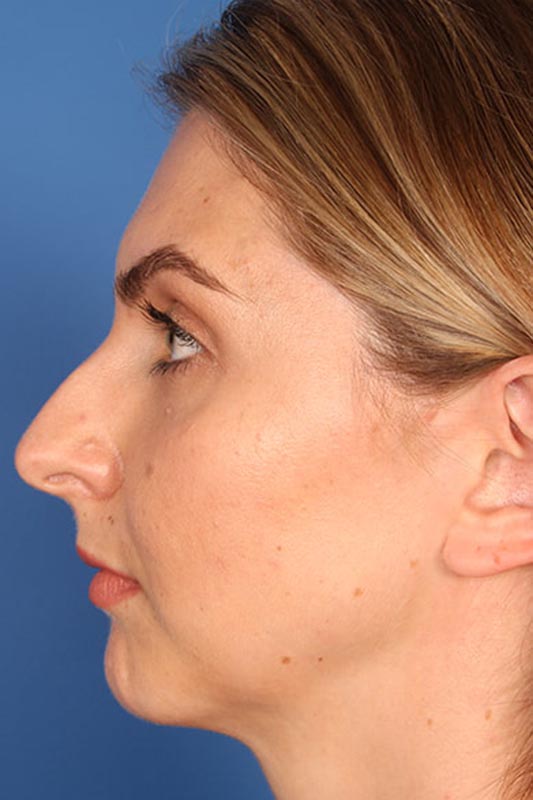 Rhinoplasty Before & After Photo