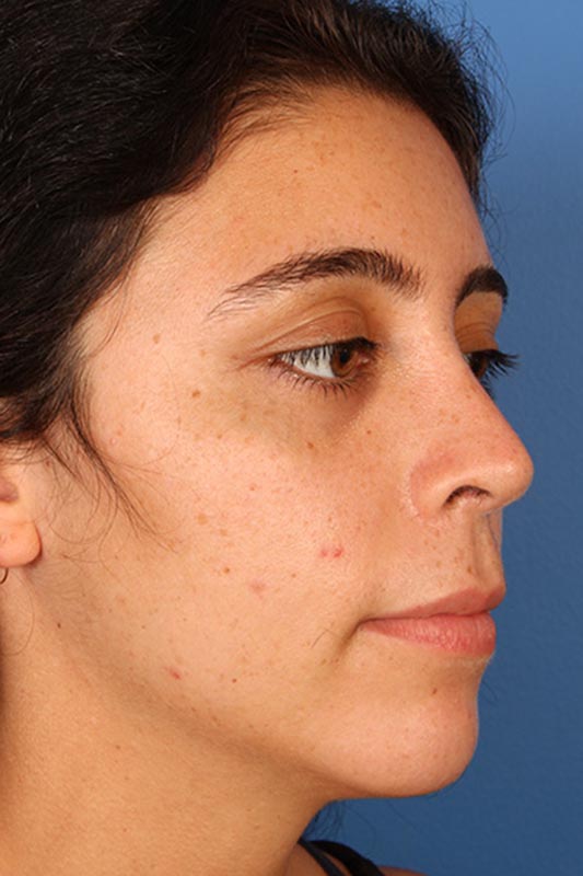 Rhinoplasty Before & After Photo