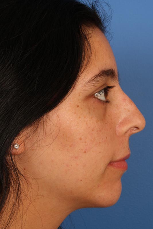 Rhinoplasty Before & After Photo